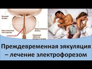 Преждевременная эякуляция - лечение электрофорезом