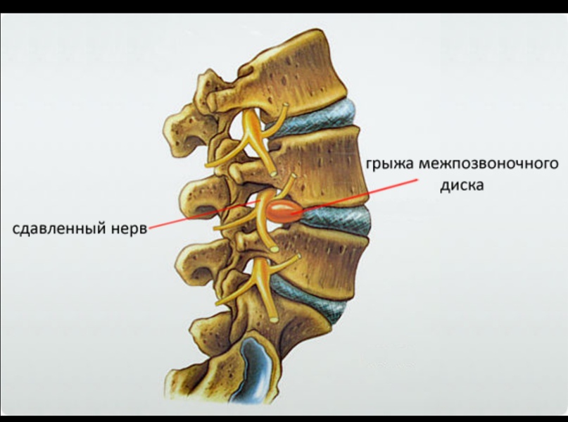 Можно ли греть грыжу позвоночника. Грыжа межпозвонкового диска поясничного отдела. Протрузии крестцового отдела позвоночника. Грыжа позвонка поясничного отдела. Грыжи дисков поясничного отдела позвоночника.