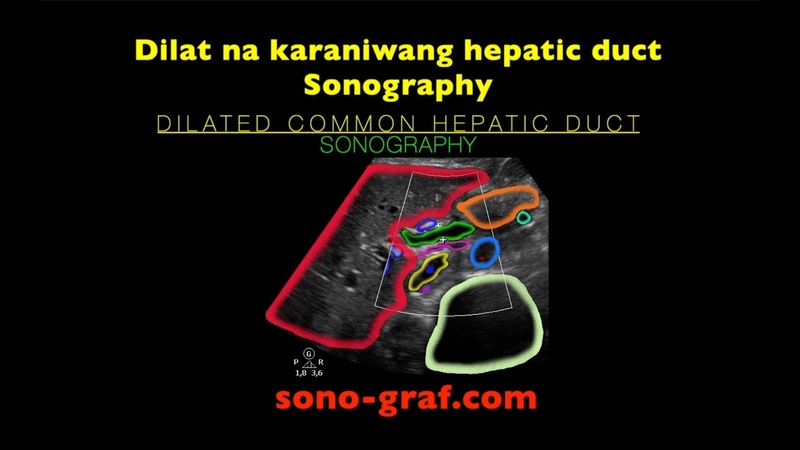 Sonography Dilat na karaniwang hepatic